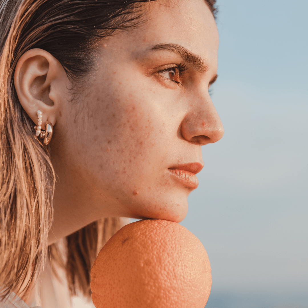 Beyond the Breakout: All About Hormonal Acne - Fri Period