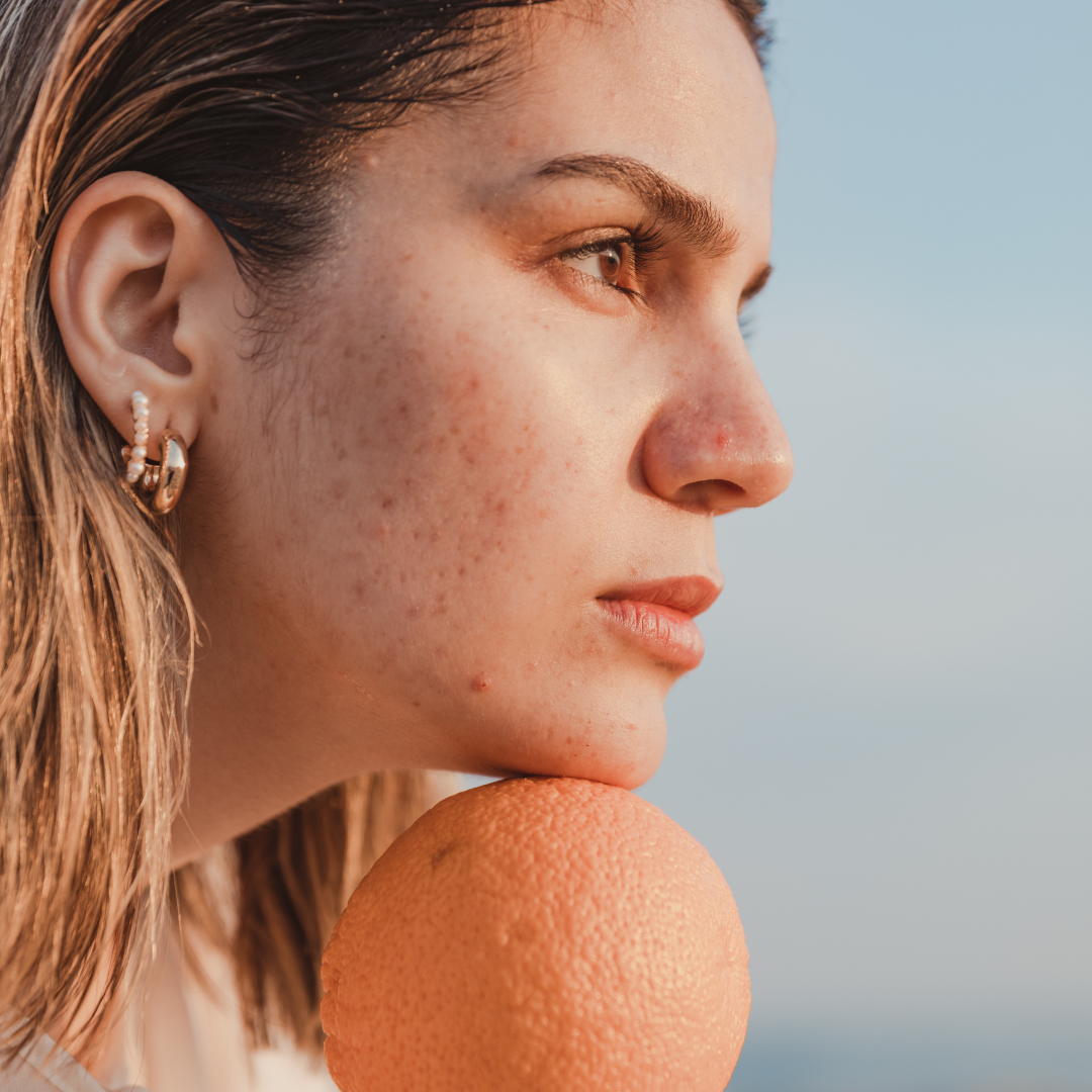 Woman with hormonal cystic acne leaning her chin on an orange